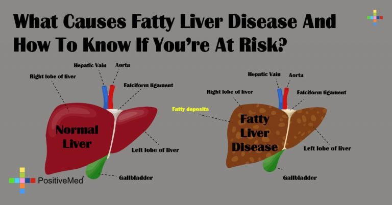 What Causes Fatty Liver Disease And How To Know If You re At Risk 