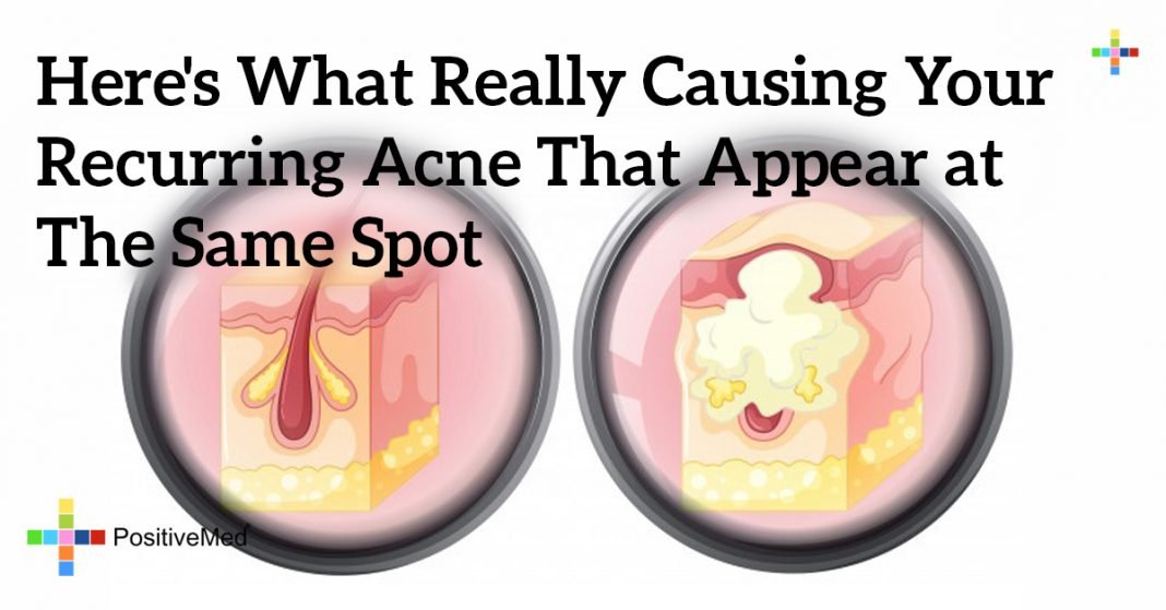 here-s-what-really-causing-your-recurring-acne-that-appear-at-the-same