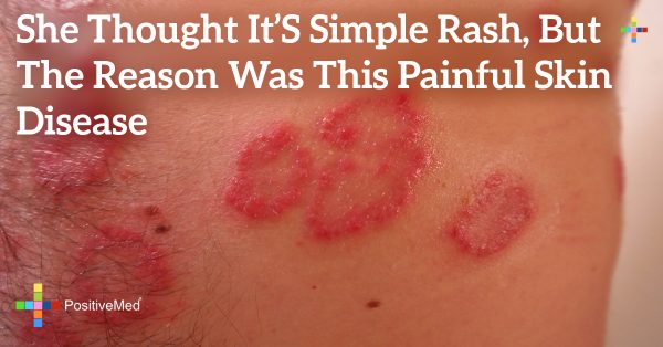 She Thought It's Simple Rash, But the Reason Was THIS Painful Skin ...