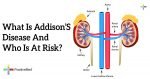 What Is Addison S Disease And Who Is At Risk PositiveMed   3582 What Is Addison’S Disease And Who Is At Risk 150x79 