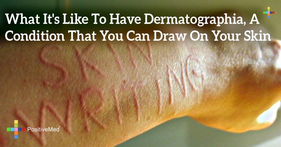What It's Like To Have Dermatographia, A Condition That You Can Draw