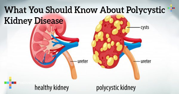 What You Should Know About Polycystic Kidney Disease