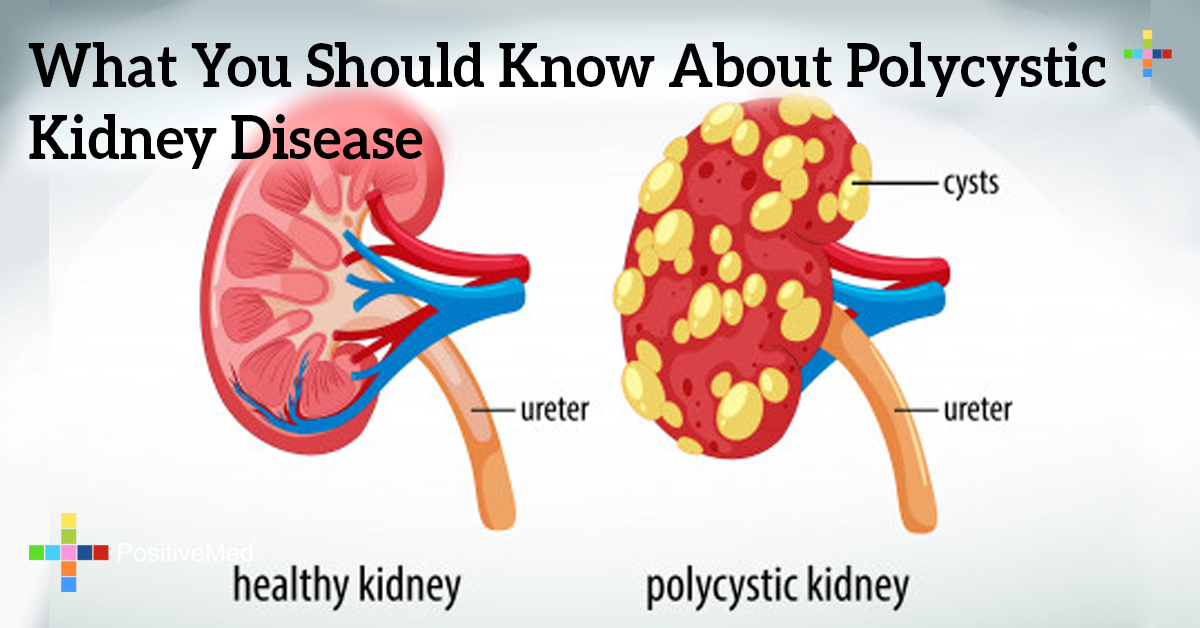 what-you-should-know-about-polycystic-kidney-disease