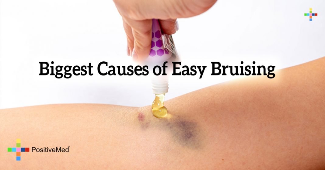 Top Reasons You Bruise Easily   4613 Biggest Causes Of Easy Bruising 1068x559 