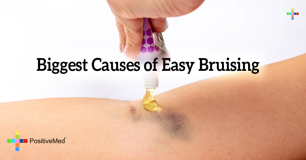 Top Reasons You Bruise Easily   4613 Biggest Causes Of Easy Bruising 