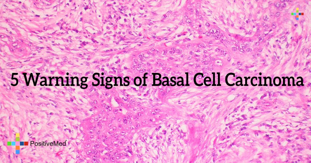 5 Warning Signs of Basal Cell Carcinoma - PositiveMed