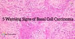 5 Warning Signs Of Basal Cell Carcinoma - PositiveMed