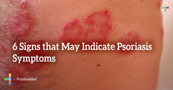 6 Signs that May Indicate Psoriasis Symptoms - PositiveMed