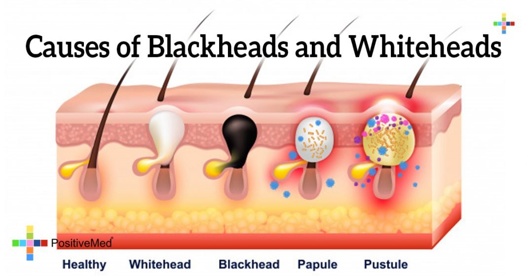 5207 Causes Of Blackheads And Whiteheads 1068x559 