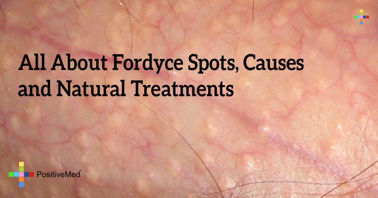5331 All About Fordyce Spots Causes And Natural Treatments 768x402 