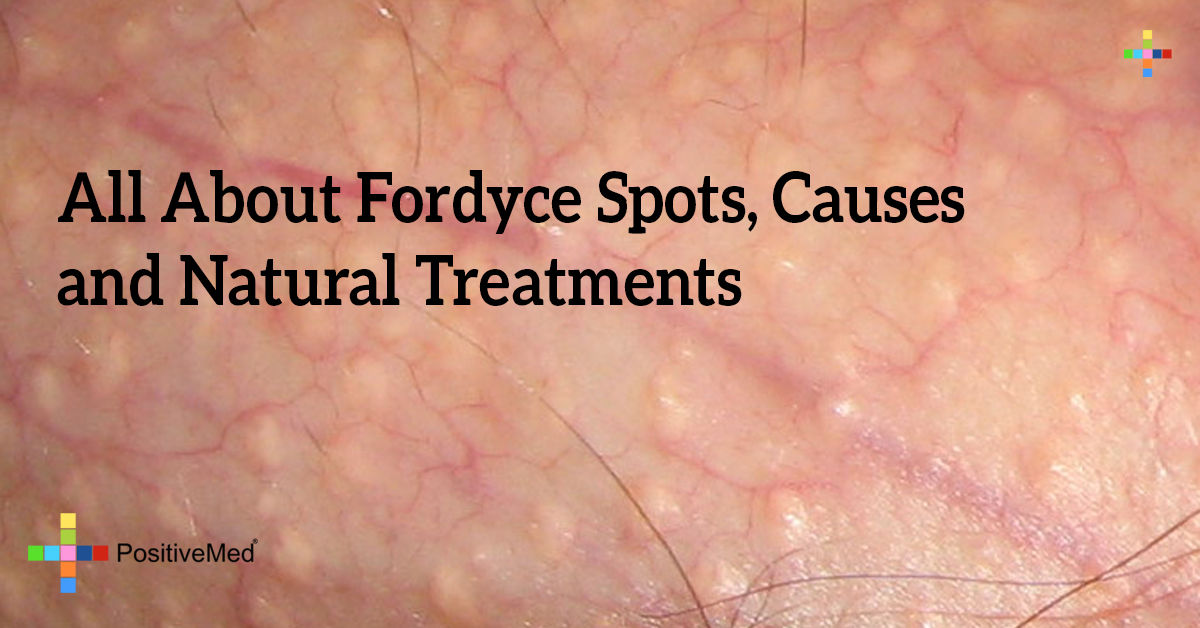 All About Fordyce Spots Causes and Natural Treatments PositiveMed