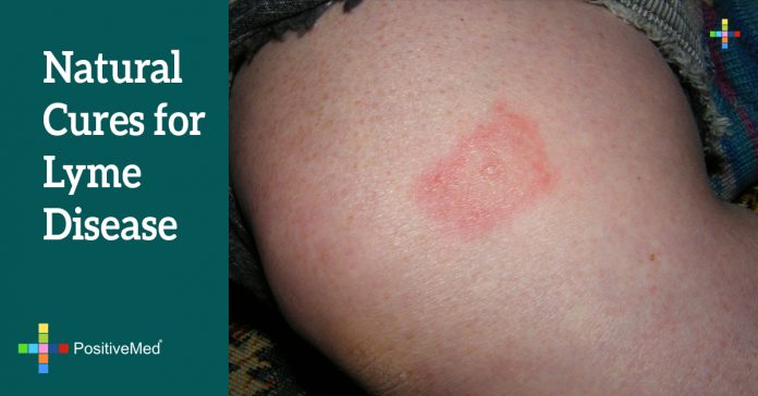 natural cures for lyme disease