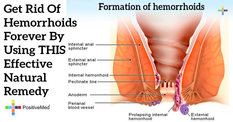 Get Rid Of Hemorrhoids Forever By Using THIS Effective