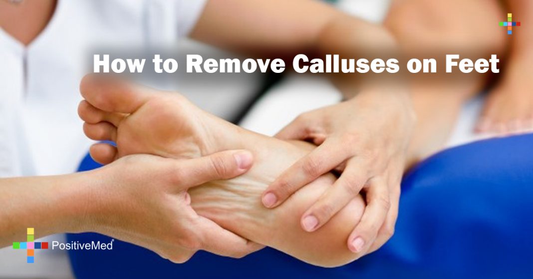 How To Naturally Remove The Calluses On Feet