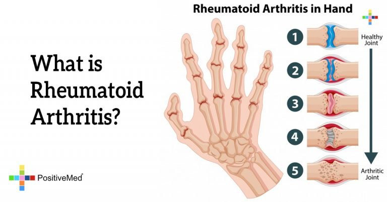 What is Rheumatoid Arthritis? - PositiveMed